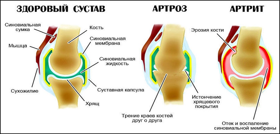 Почему болят суставы после горячей ванны